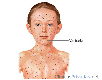sintomas-de-la-varicela
